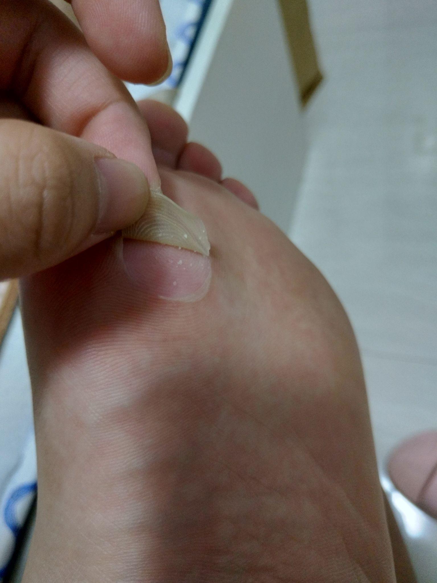 我与脚上的水泡06