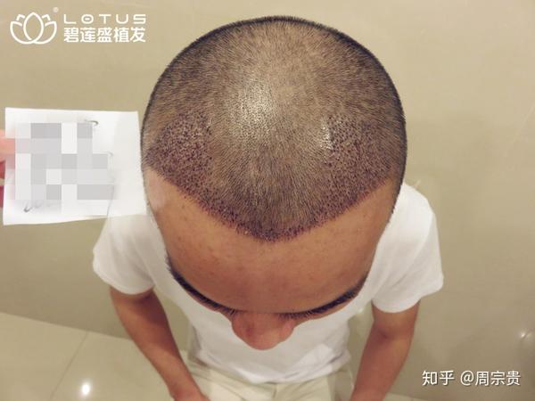 从额角开始的脱发,为什么那么难发现? - 知乎