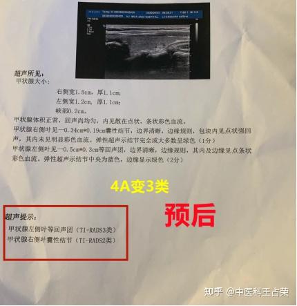 危險解除3個療程甲狀腺4a結節降至3類她的做法請轉給所有人