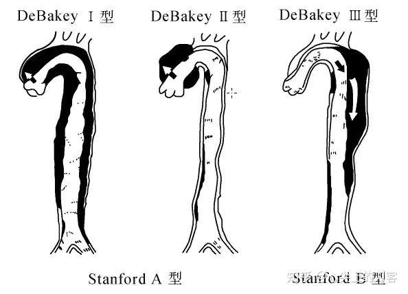 stanford分型图片