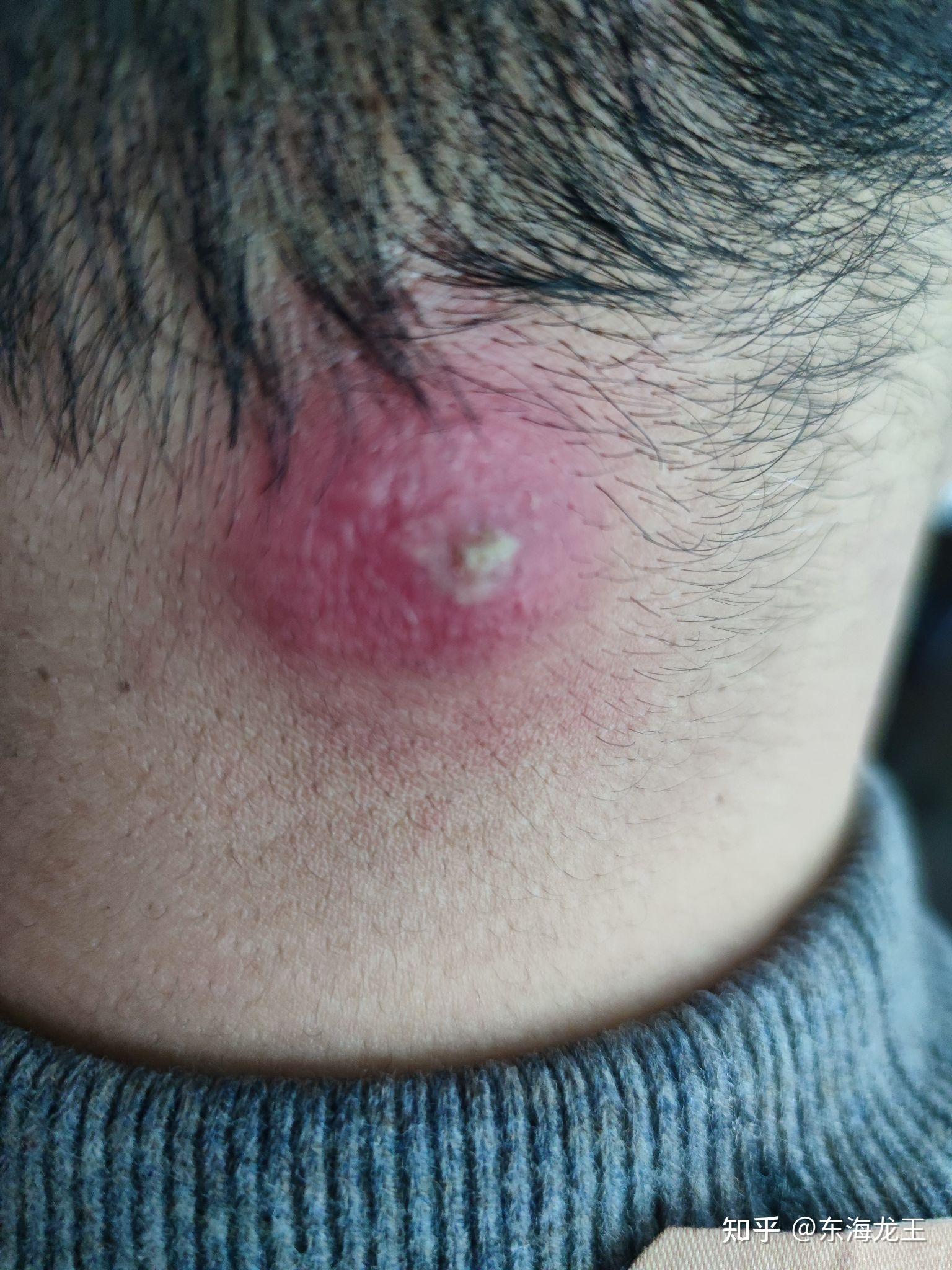 是毛囊炎,武汉冻雨忙着工作也没理会,如果这时候可以积极治疗就不会