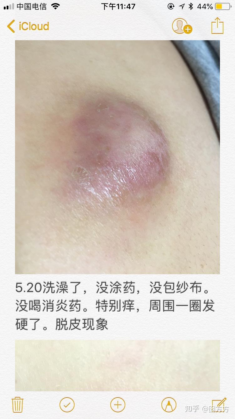 原来我长的不是疖子而是皮脂腺囊肿又称粉瘤