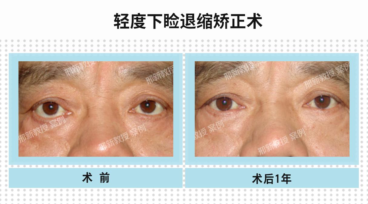 眼袋手术失败的并发症有哪些 好修复吗 知乎 眼袋手术失败的并发症有哪些 好修复吗 知乎