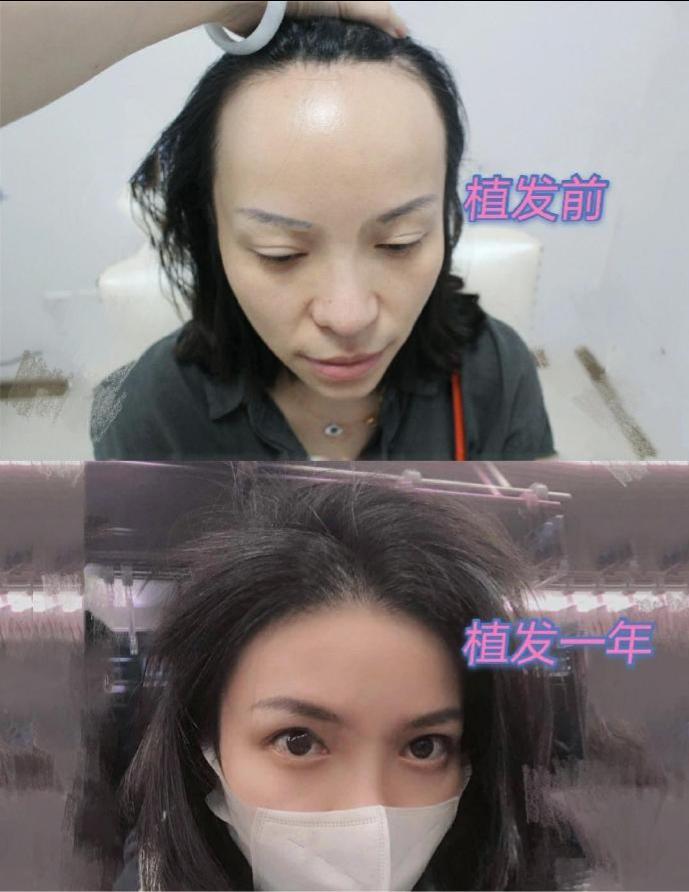 丹东植发哪家最好(植发一般去哪里比较好)
