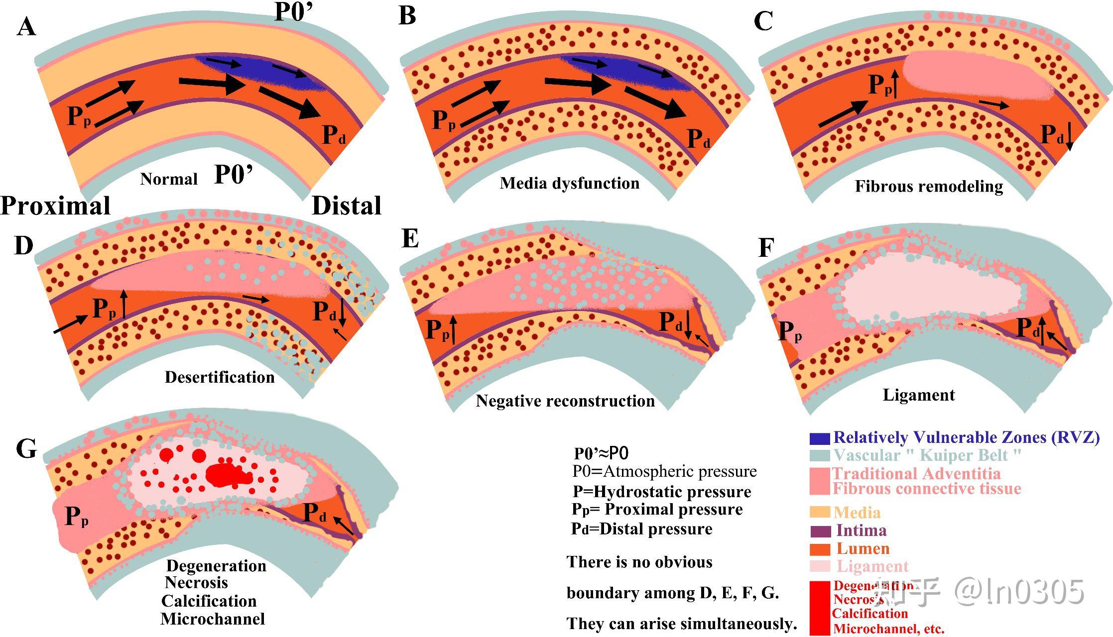 血管慢性完全闭塞(CTO)的发病机制 Pathogenesis of Vascular Chronic Total Occlusion ...