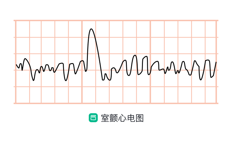 房颤与室颤,“傻傻分不清楚”? - 知乎