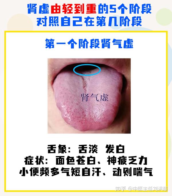 肾虚共有5个发展阶段,舌象及对应表现,对照自己发展到哪一步? - 知乎