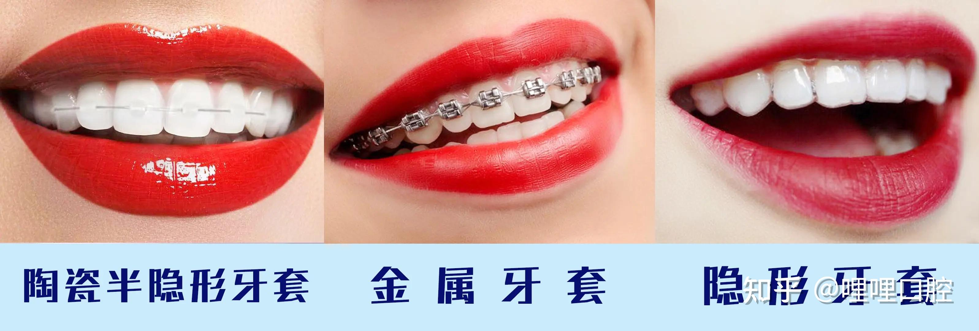 三,怎么选择牙齿矫正器类型