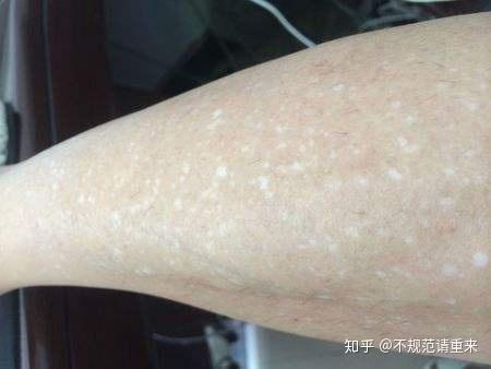 腿上有白斑怎样能治好