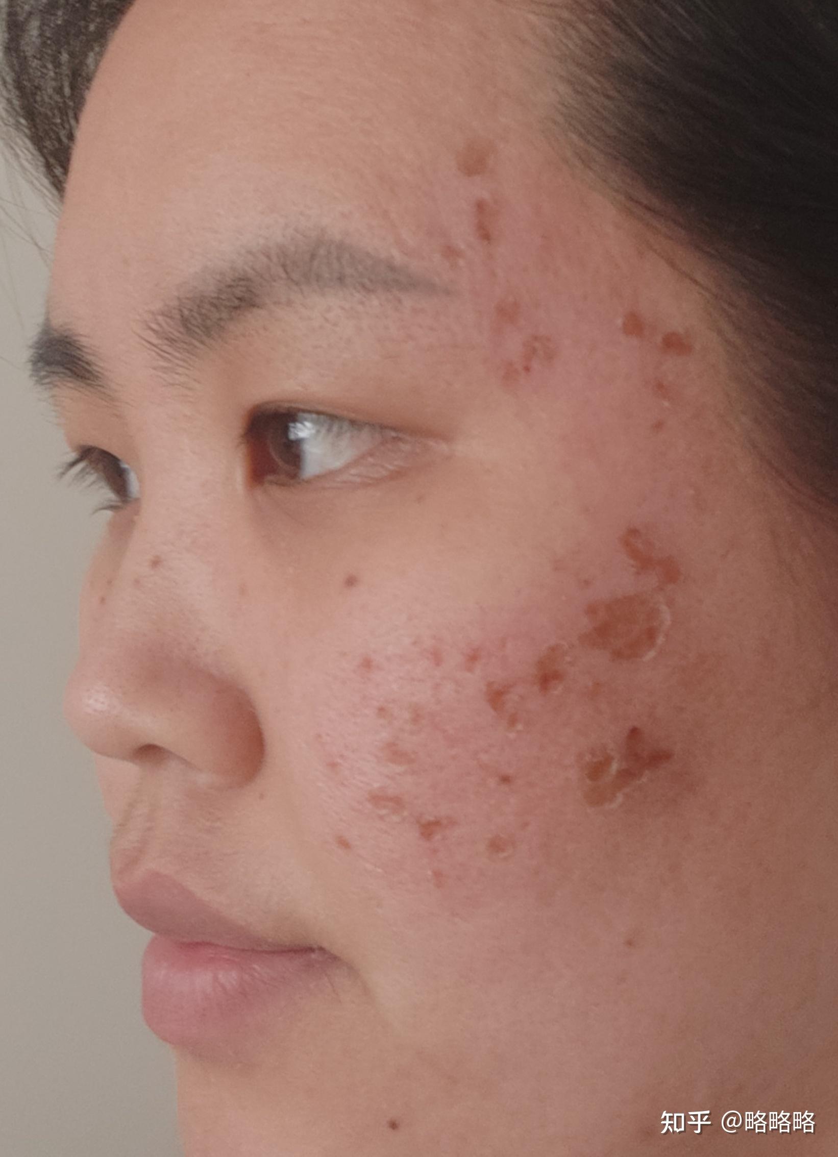 二氧化碳点阵激光恢复记录以及一个普通人的医美经历与心态