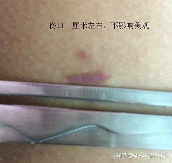 得了腰椎间盘突出或者腰椎管狭窄应该怎么办 知乎
