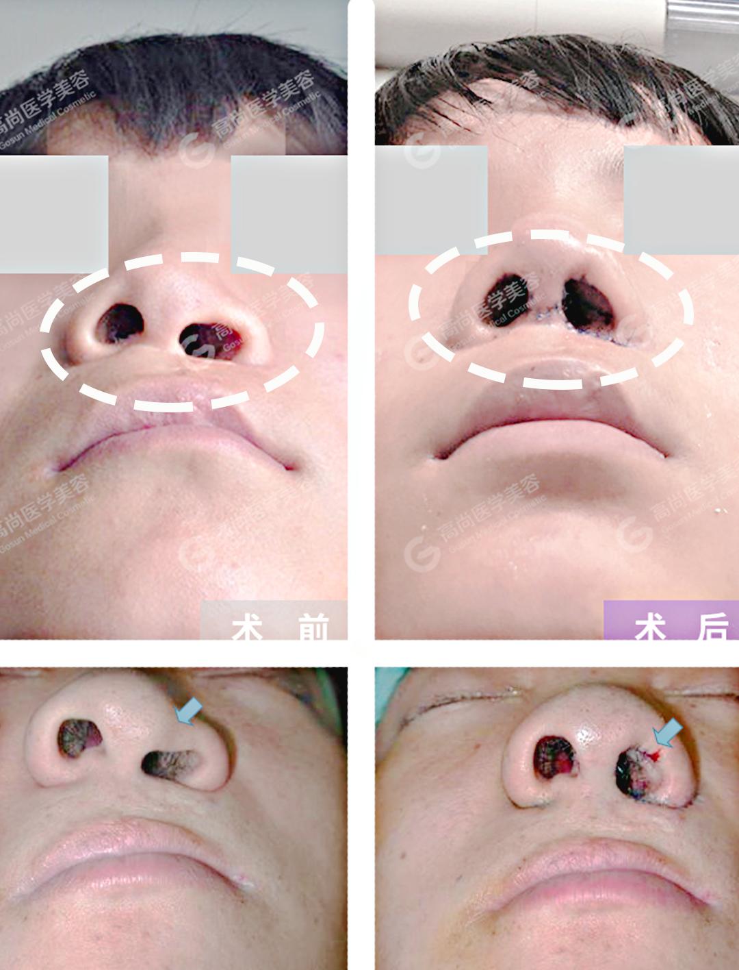 唇裂二次修复手术图片唇裂修复合成一期做