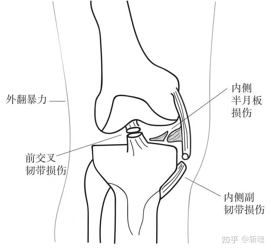 内侧副韧带损伤表现图片