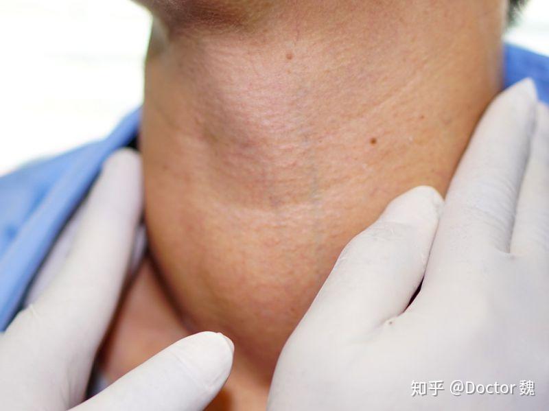 甲状腺结节穿刺疼吗甲状腺疾病患者的饮食要注意什么