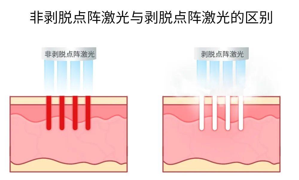 点阵激光能治鸡皮肤吗(点阵激光可以治疗哪些皮肤问题)