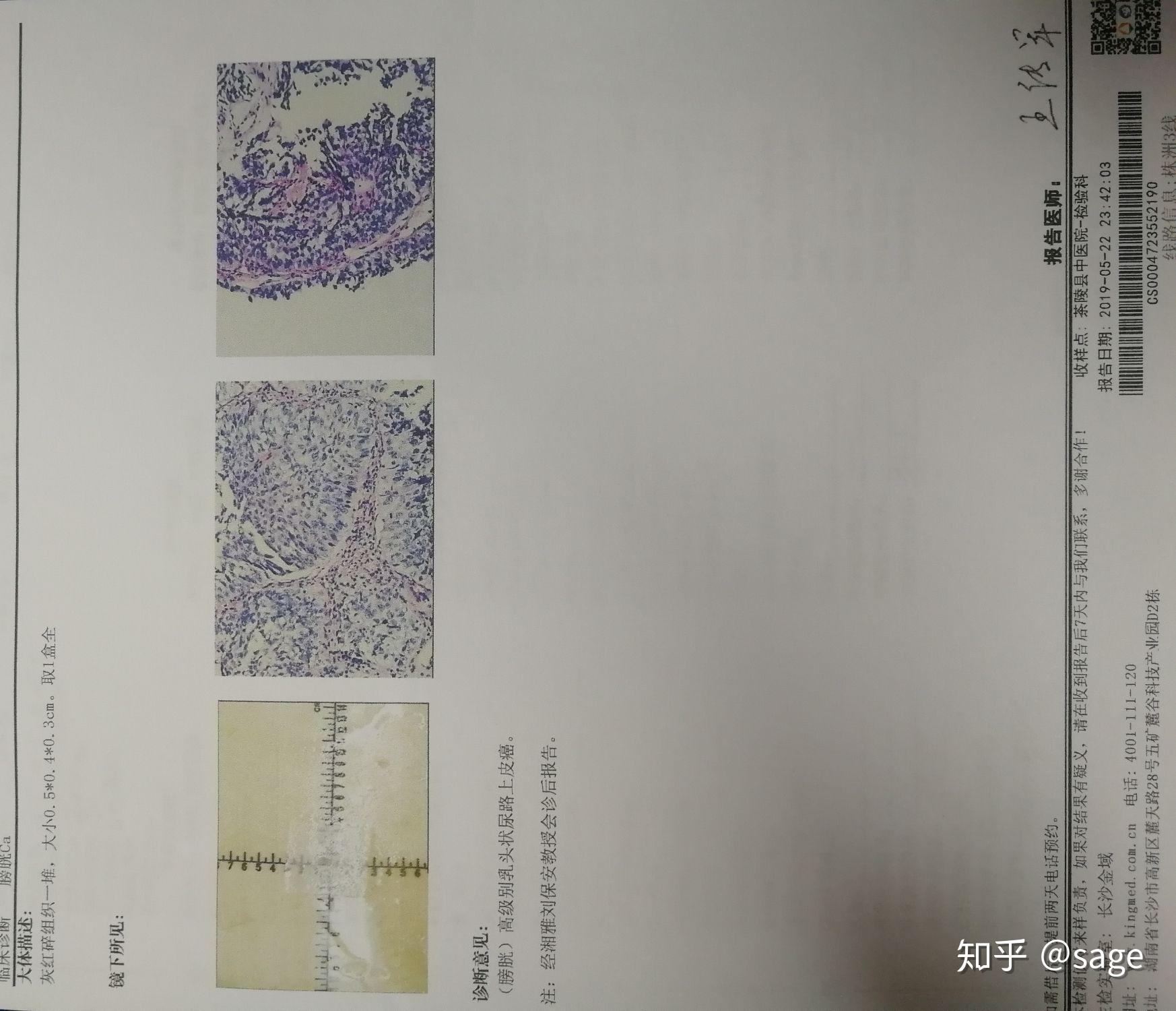 膀胱癌 病理报告图片