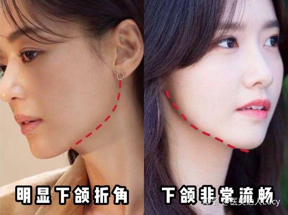 下颌骨作为下面部的"承重墙",其发育状态很重要,下颌角外翻的脸相对内