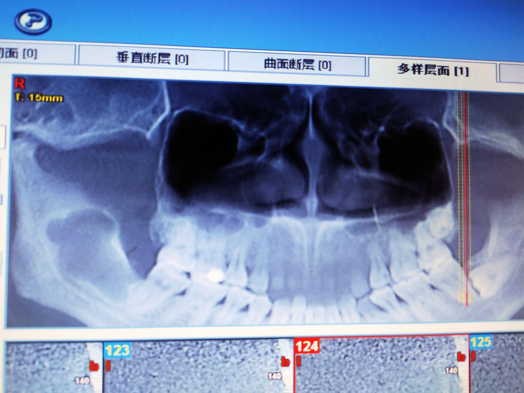 我的左下颌骨牙源性角化囊肿治疗经历 - 知乎