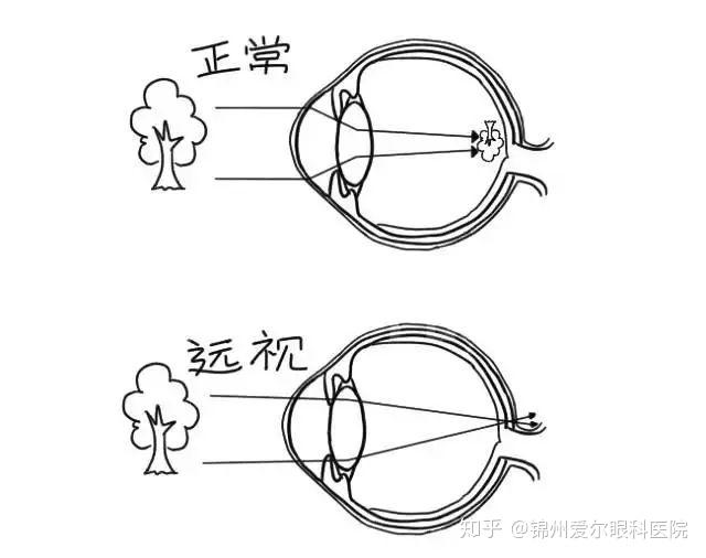 配什么样的眼镜治散光,配什么样的眼镜治散光好