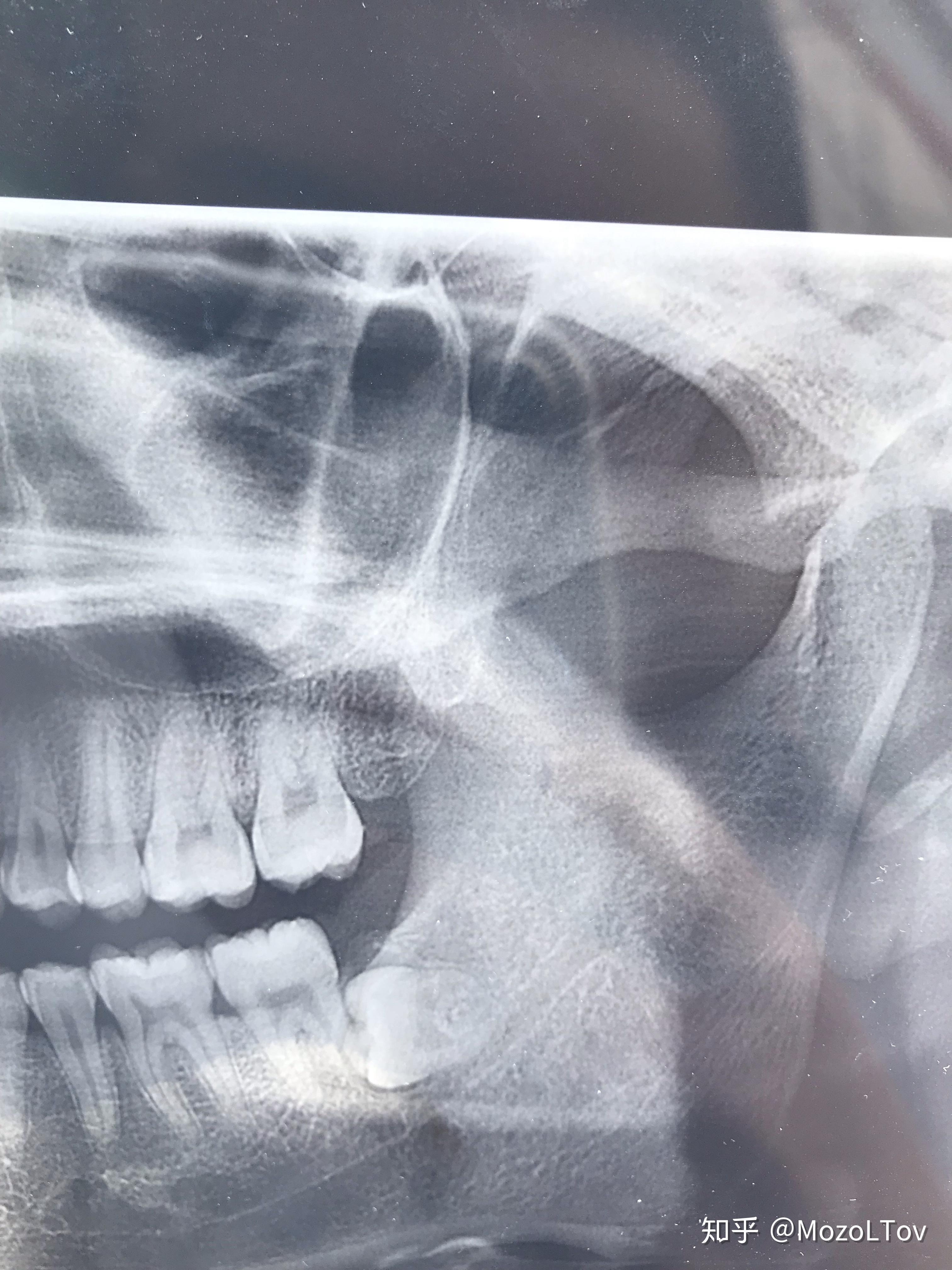 想问一下横向阻生齿离神经管特别近那种永久性面瘫的概率有多大