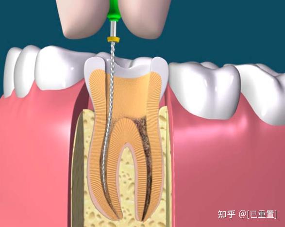 根管治療竟也有風險? - 知乎