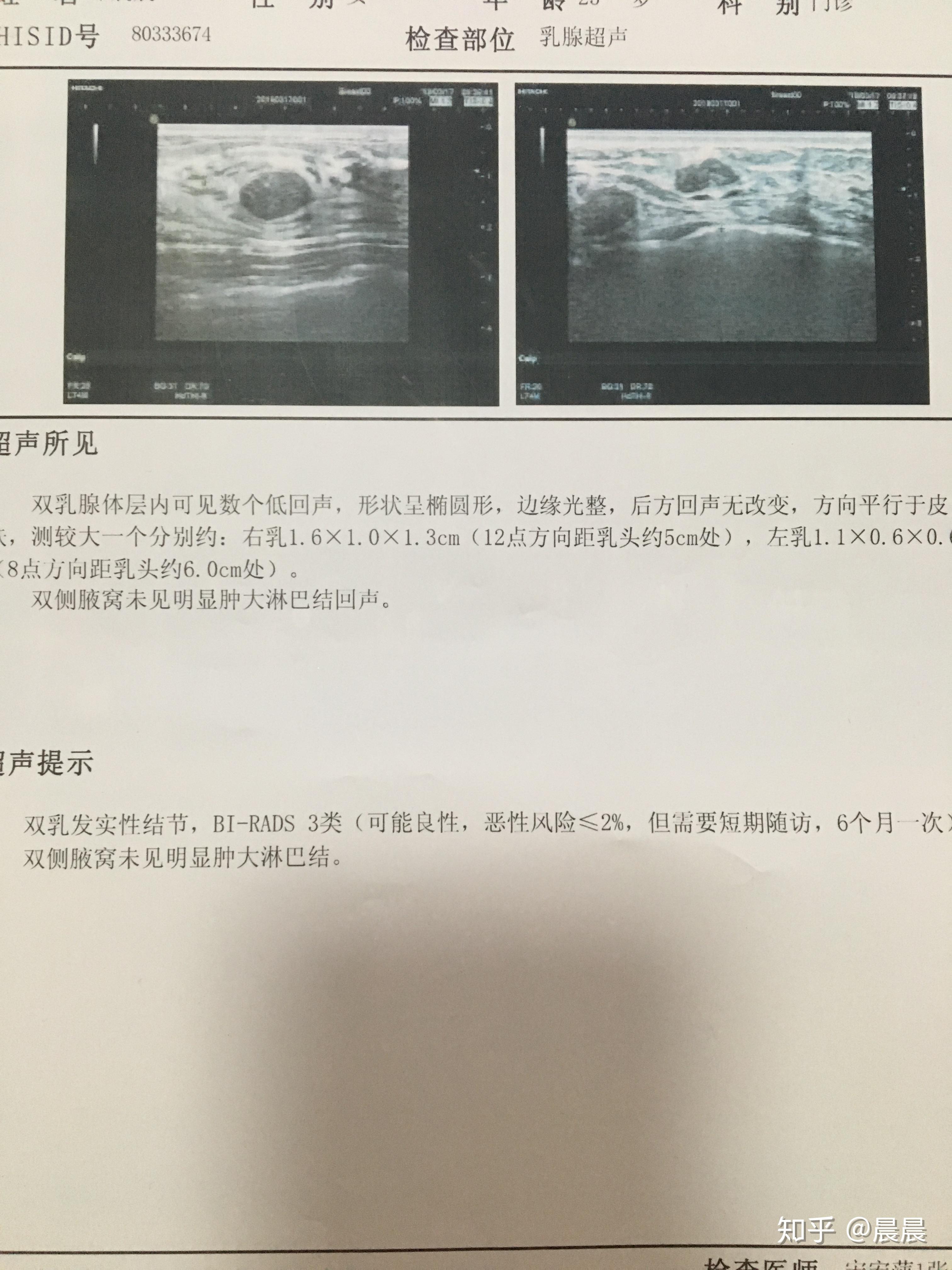 记一次乳腺纤维瘤微创手术