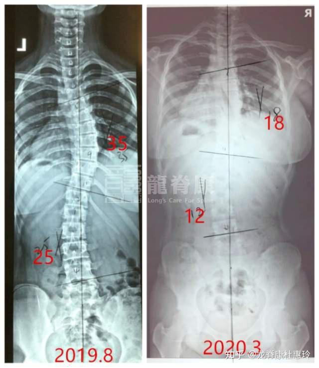 13岁侧弯女孩,因半年来每天坚持做训练,剃刀背减少10° - 知乎