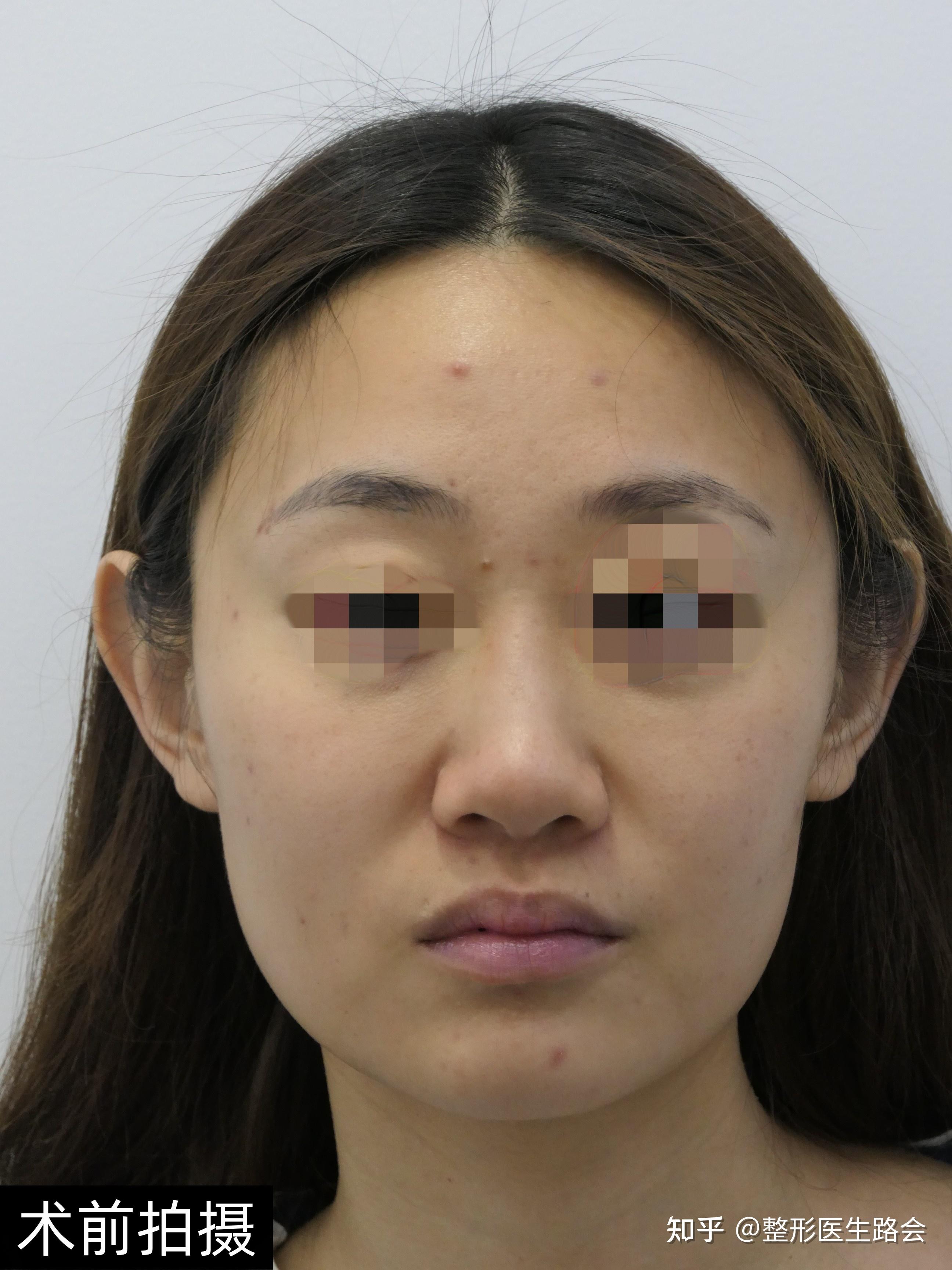 20岁姑娘膨体隆鼻记录：术前、术后即刻、第55天效果变化