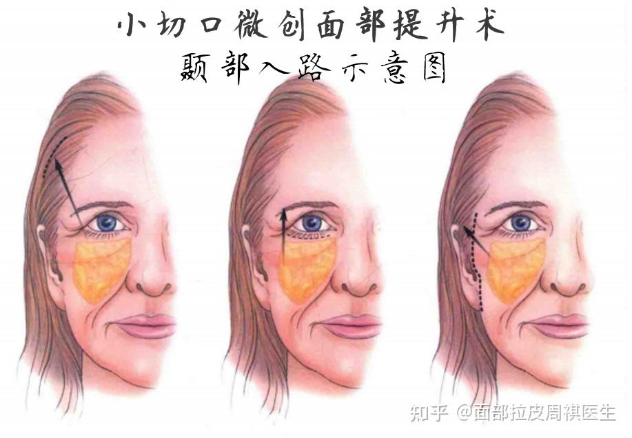 面部提升术小切口微创面部提升术微拉皮