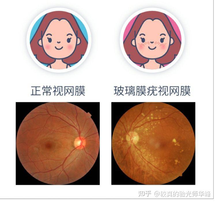 驗光配鏡檢查眼底時眼底照相機提示有玻璃膜疣怎麼辦