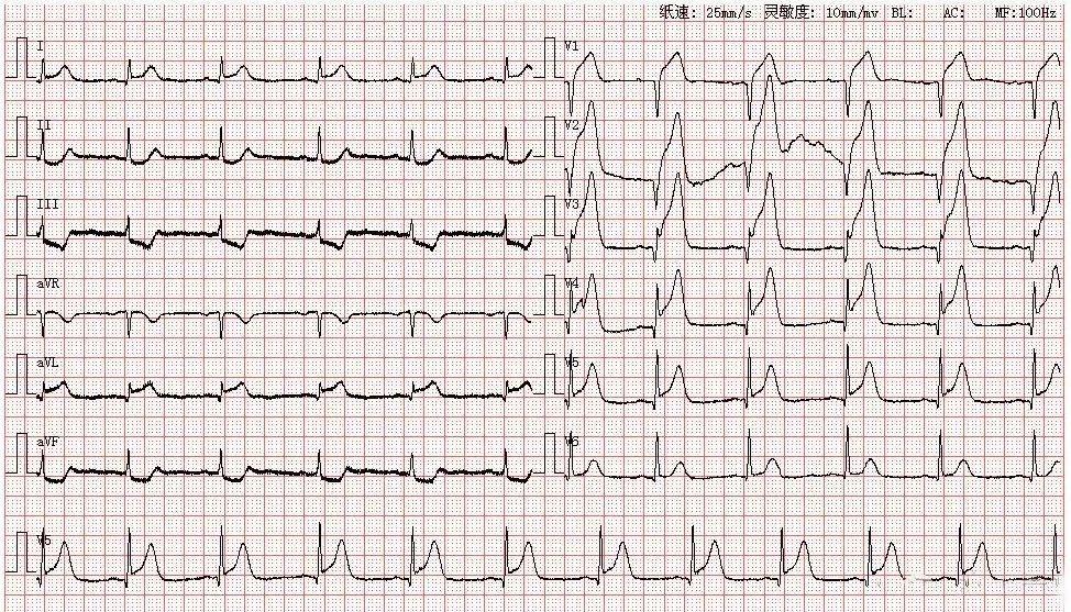 心电图图库丨心肌梗死系列