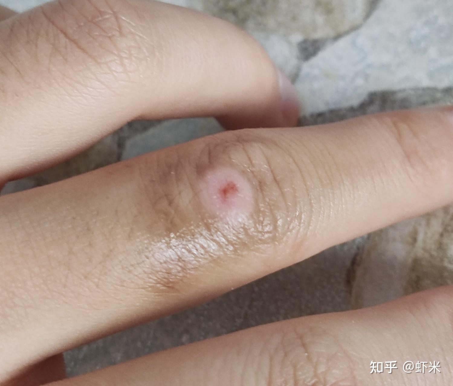 多图慎入液氮去瘊结痂10天脱落