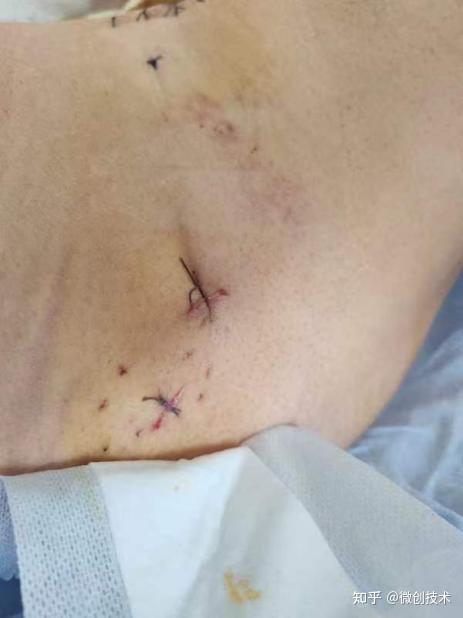 案例解析|西南医科大学附属医院c3型骨盆骨折微创手术