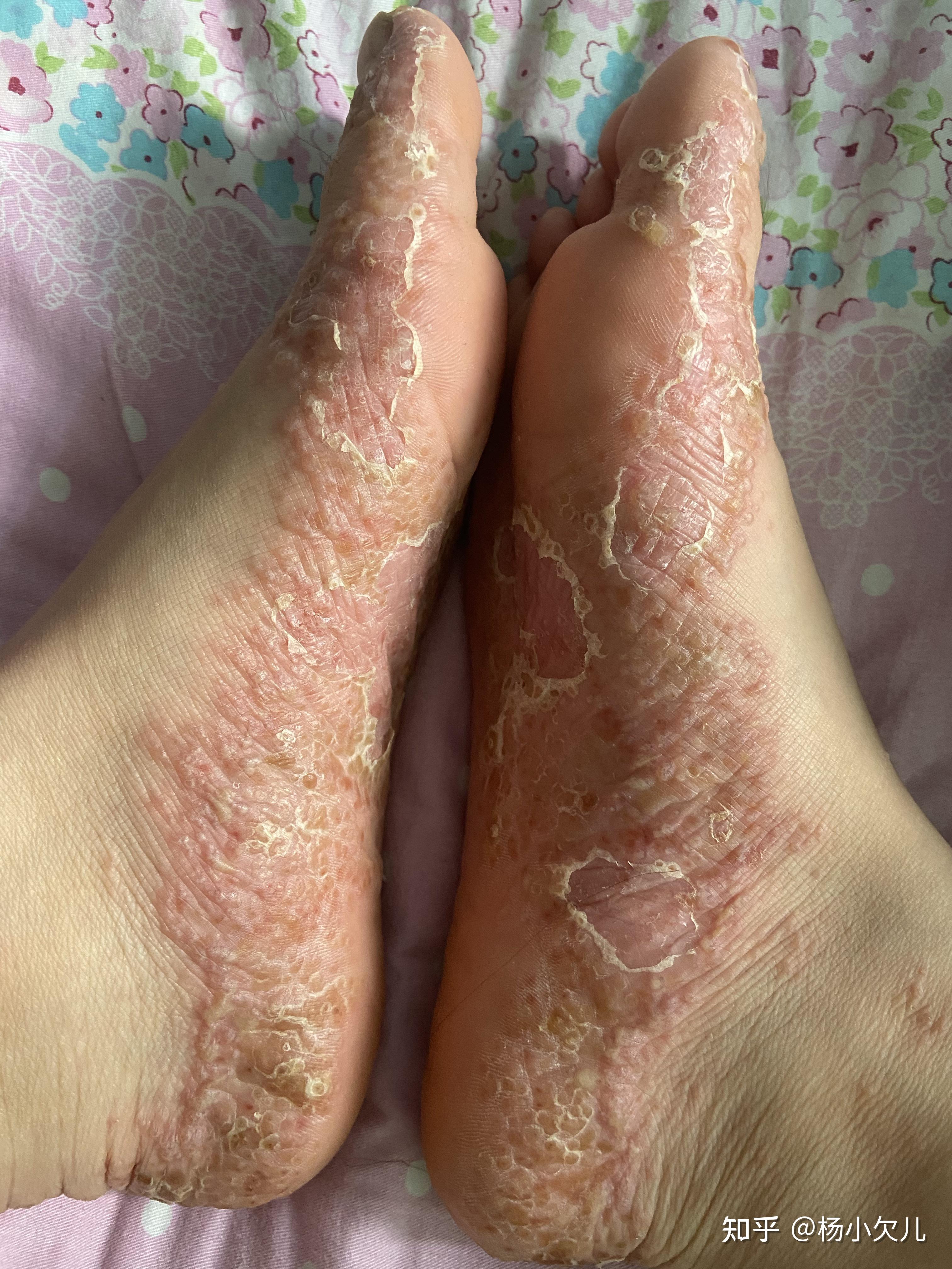 这个时候我的手脚已经是这个样子了仍然没效果,我又去看了中医,说是