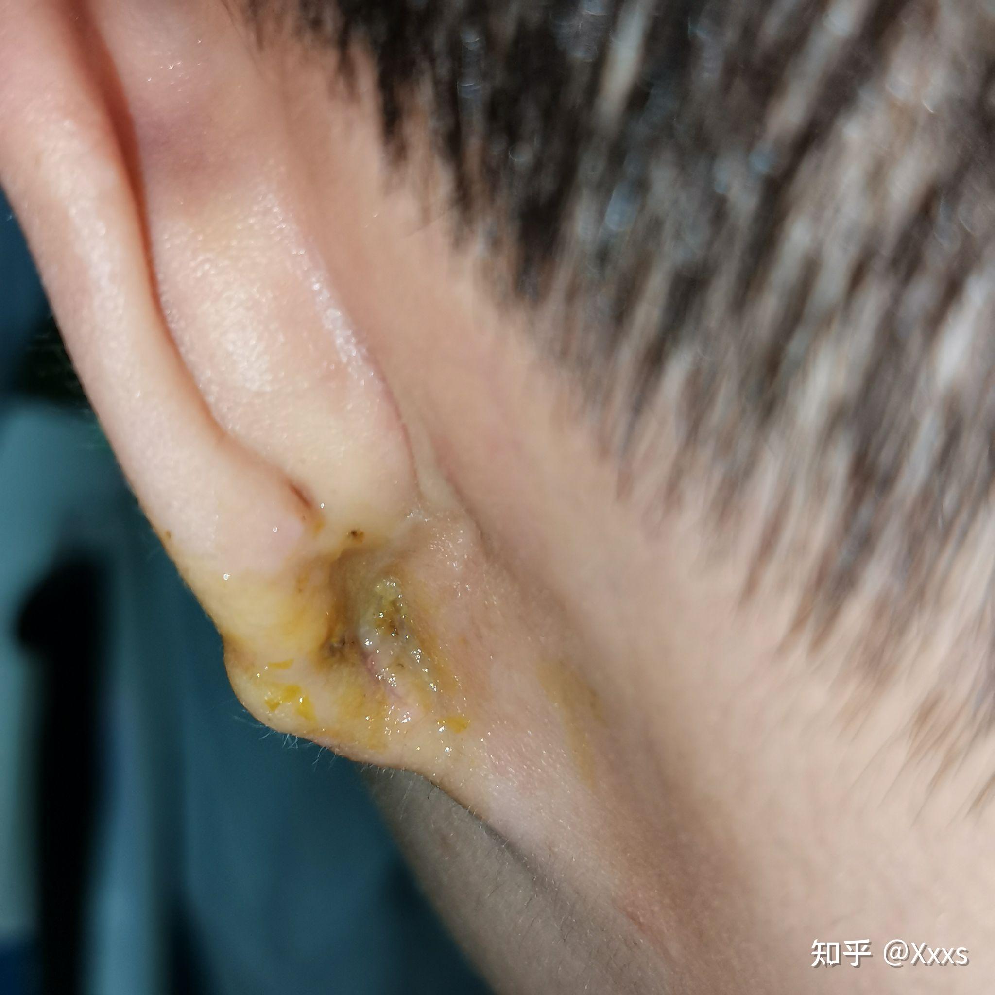 耳垂长了瘢痕疙瘩,记录术后恢复 - 知乎