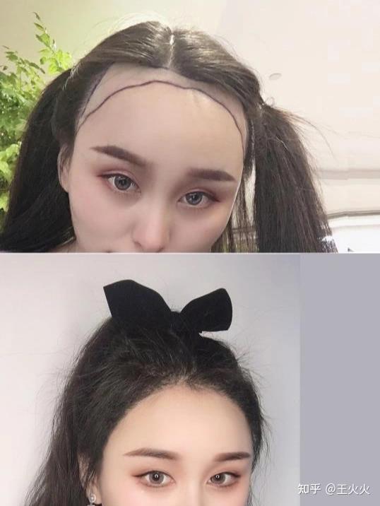 中国比较靠谱的植发(国内哪家植发机构比较正规?)