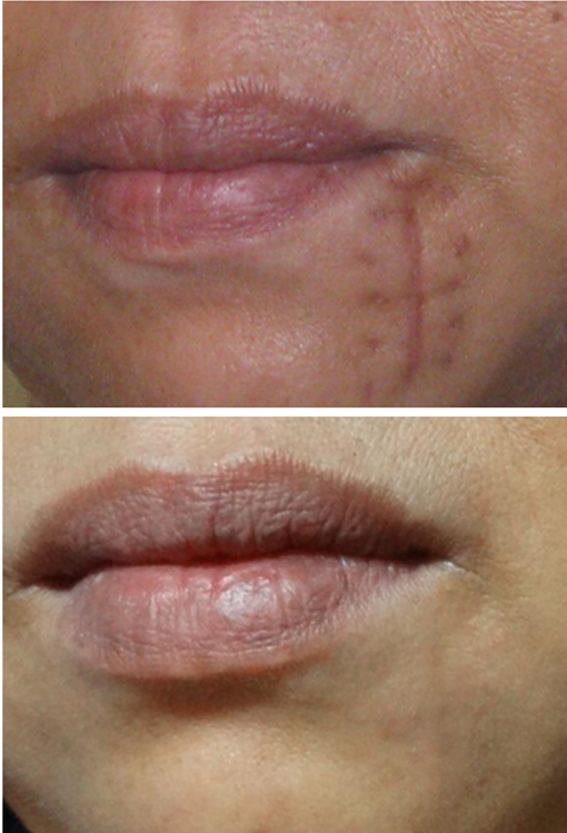 疤痕的完美修复