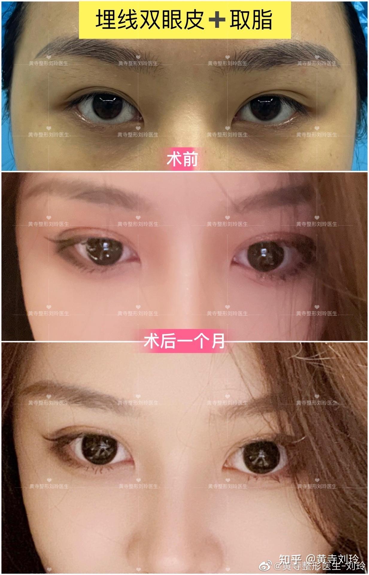 北京埋线双眼皮77取脂术后一个月