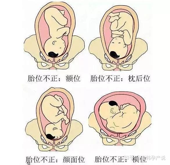 分娩正下方图片