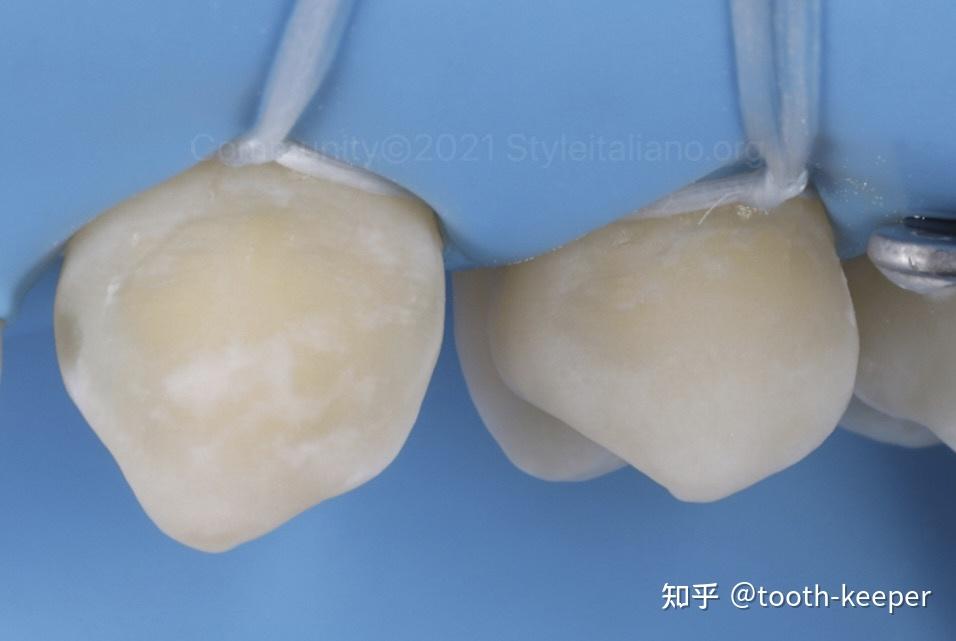 minimallyinvasivetreatmentofcervicalcaries