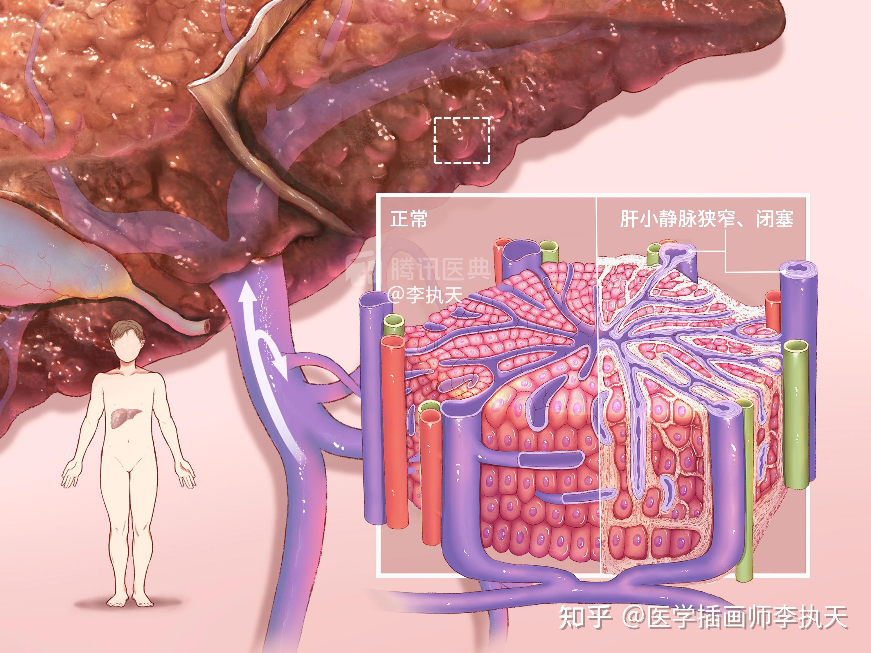 以下是我的部分作品:医学插画师不仅需要绘画功底,更加需要对医学知识