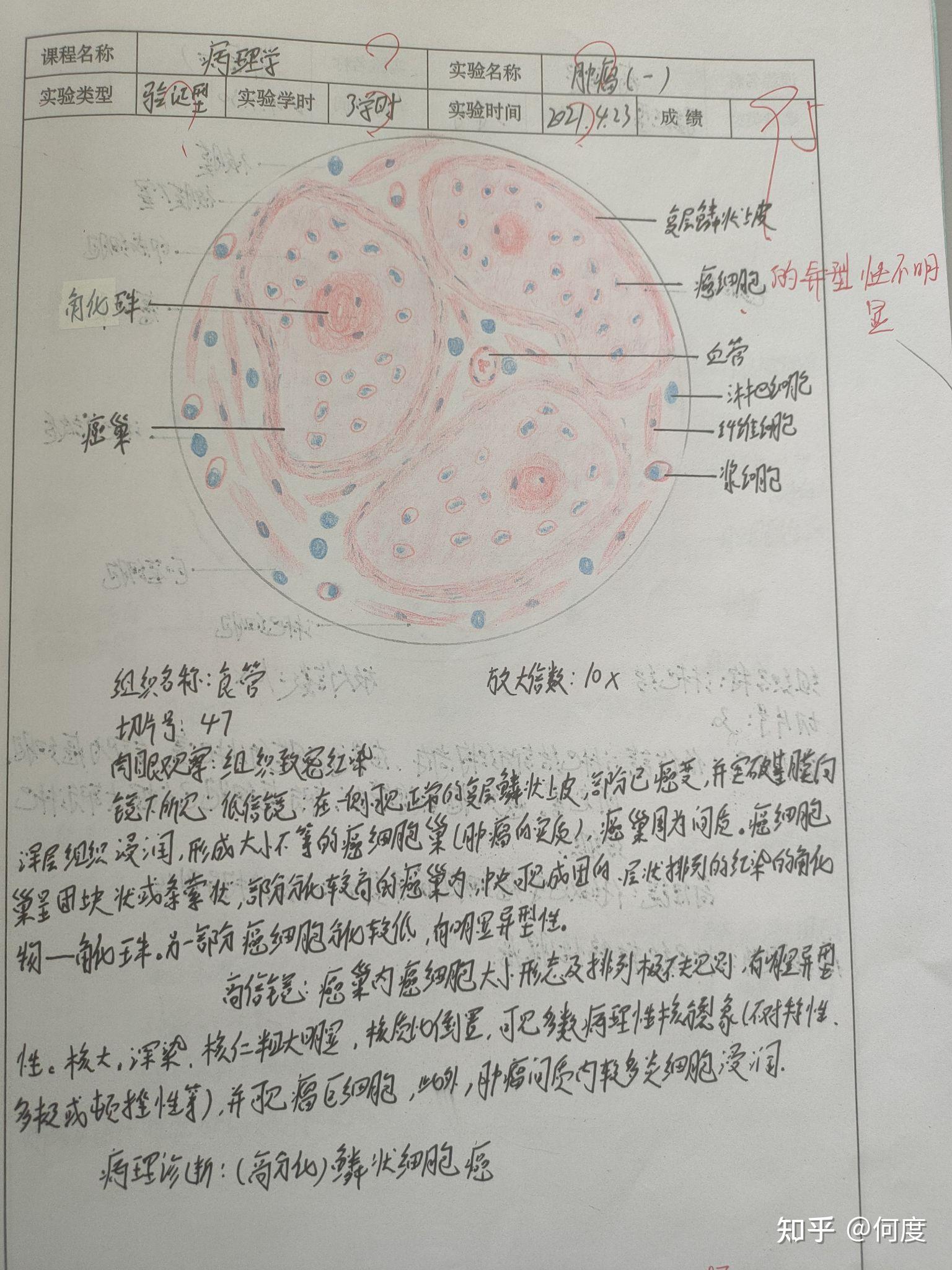 心肌炎7.冠狀動脈粥樣硬化6.淋巴結轉移性腺癌5.(高分化)鱗狀細胞癌4.