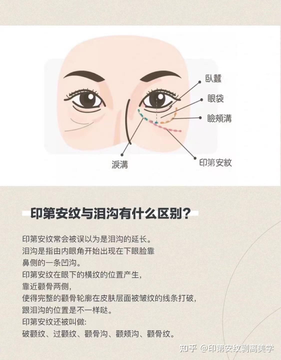 印第安纹是什么搞懂这4大问题印第安纹会自行消退