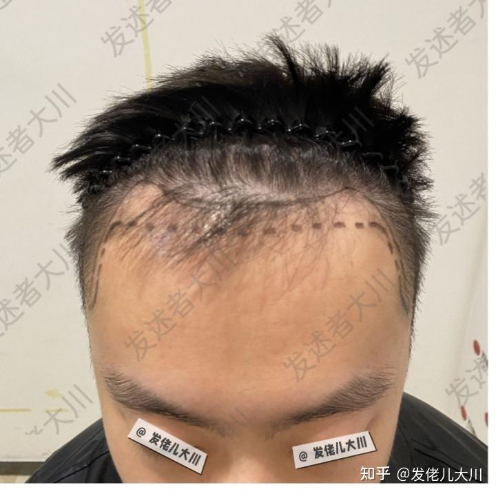 黑暗植发(种植黑发要多少钱)