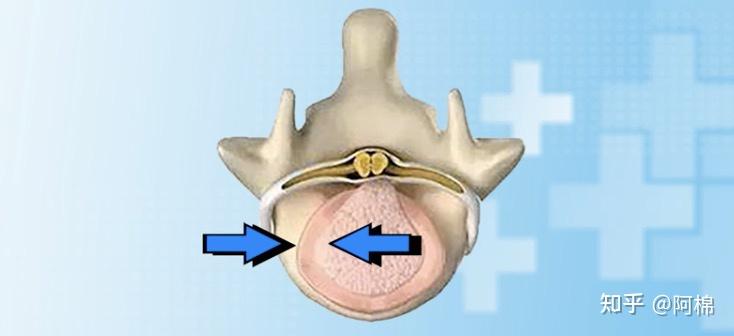 所以我之前也以為腰間盤突出跟頸椎病一樣是骨頭的生理曲度有問題了