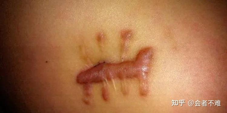 疤痕体质的外在表现