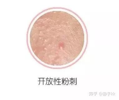额头反复长闭口,难道是清洁不到位? - 知乎