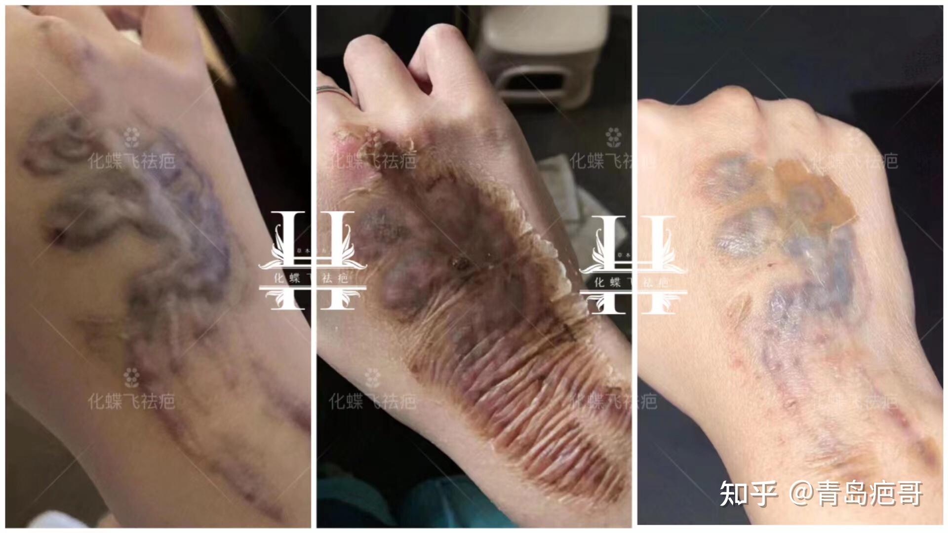 洗纹身增生疤痕怎么修复