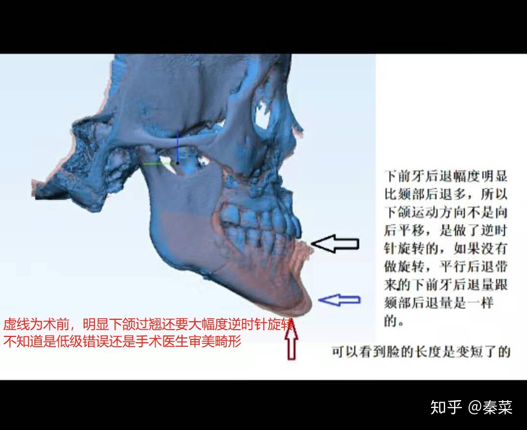 武漢大學口腔醫院正頜手術後鼻中隔和上頜竇穿孔