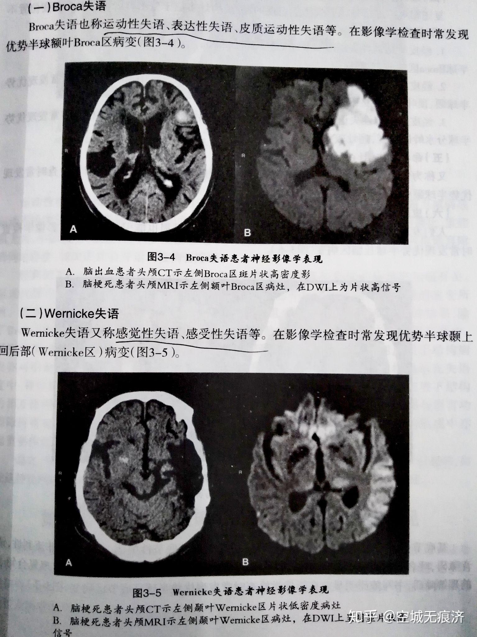 【补充】代表性的语言障碍是脑卒中,脑外伤导致的失语症,大脑功能发育